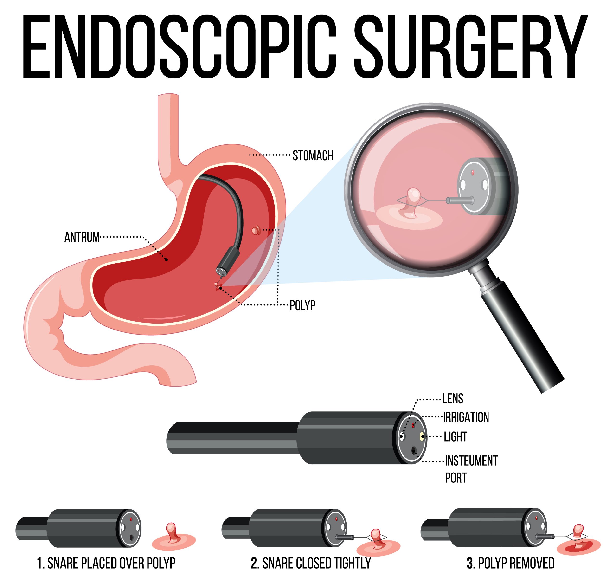 Diagram showing endoscopic surgery Diagram showing endoscopic surgery illustration