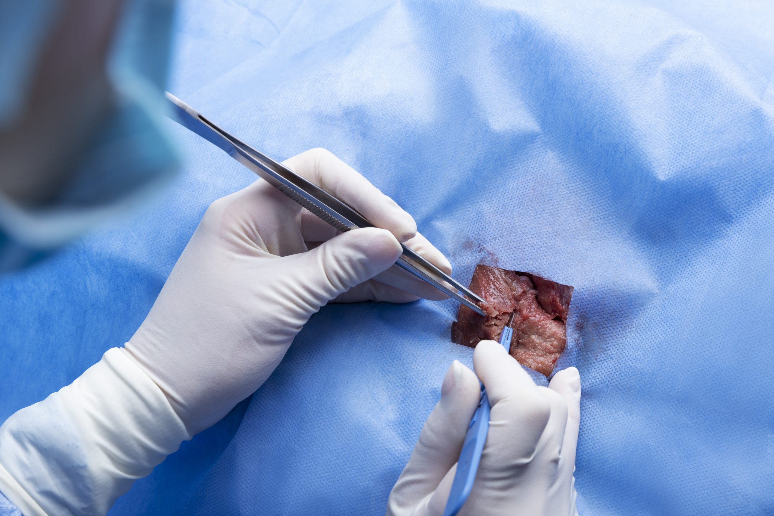 Laparoscopic Laparoscopic